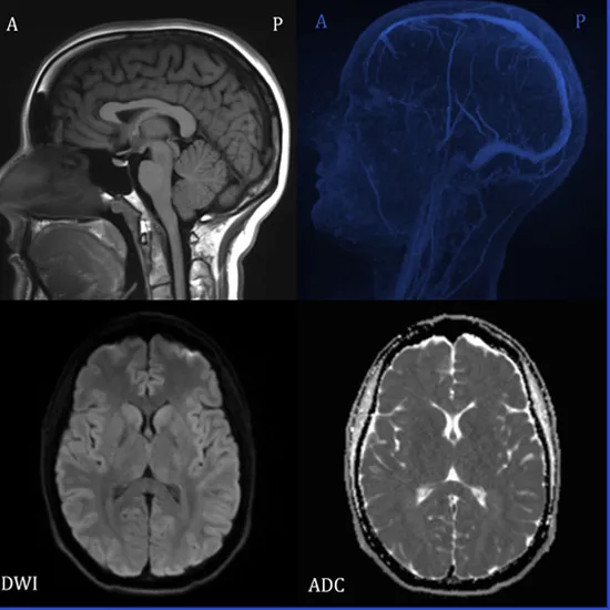 MRI Brain Epilepsy Protocol